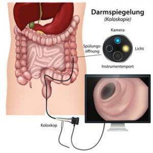 Darmspiegelung als Krebsvorsorge