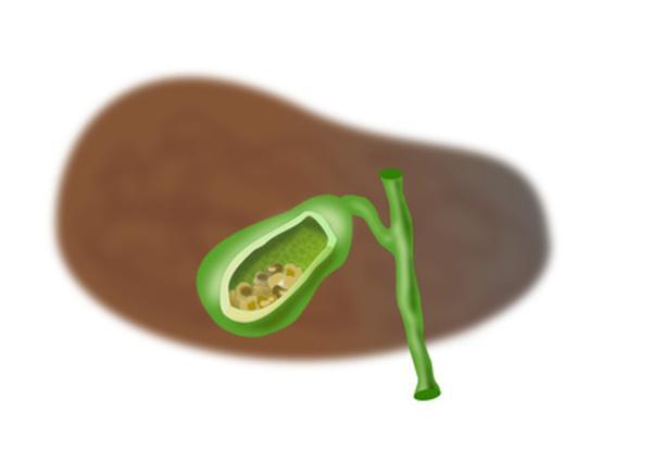 Nieren- und Gallensteine 