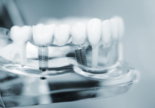 Zahnimplantate benötigen Verankerungen im Kiefer