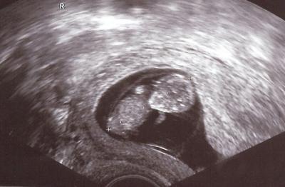 Embryo im Mutterleib 