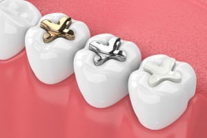 Zahnfüllungen aus Amalgam sollen verboten werden, (c) getty Images / ayo888