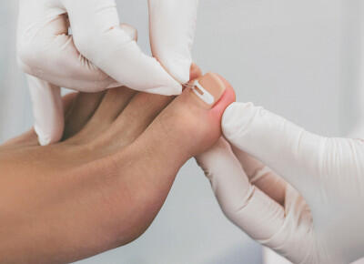 Medizinische Fußpflege / Nagelspange,  (c) getty Images / peakSTOCK