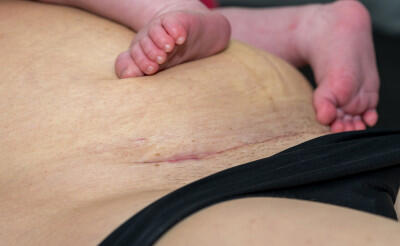 Kaiserschnittgeburten nehmen zu ,  (c) getty Images / David Ziegler