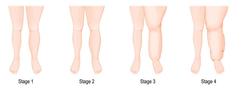 Fortschreitendes Lipödem - Stadium 1, Stadium 2, Stadium 3 und Stadium 4 