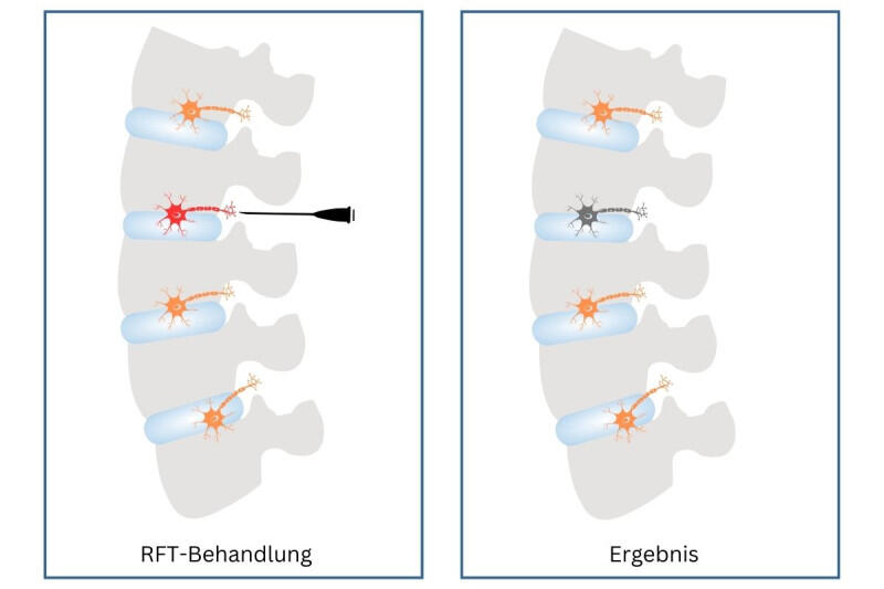 RFT-Behandlung an der Wirbelsäule