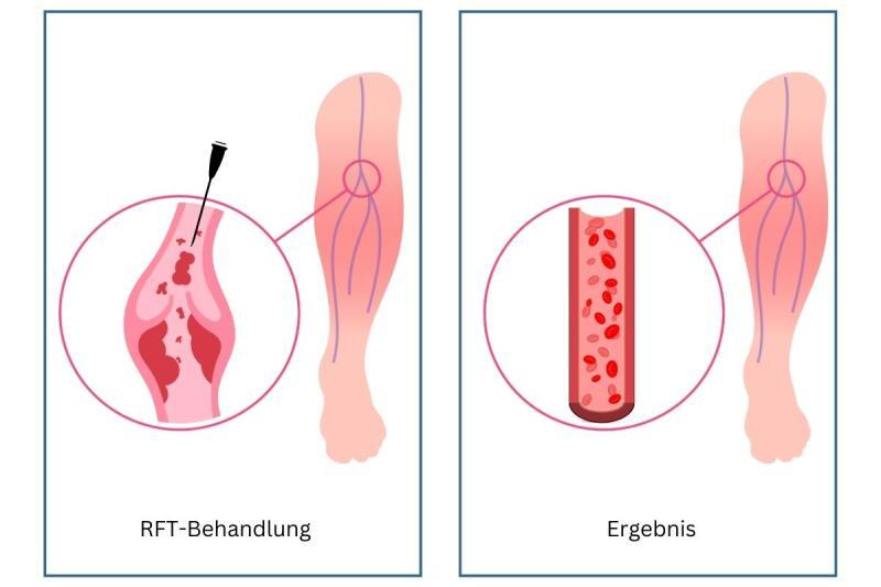 Radiofrequenztherapie (Radiowellentherapie) bei Krampfadern