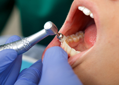professionelle Zahnreinigung-Krankenkasse