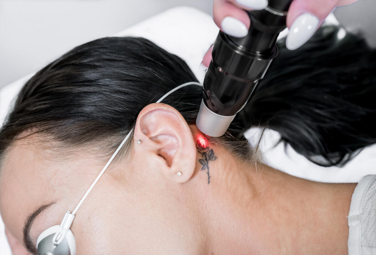 Tattoo entfernen Tattoo entfernen