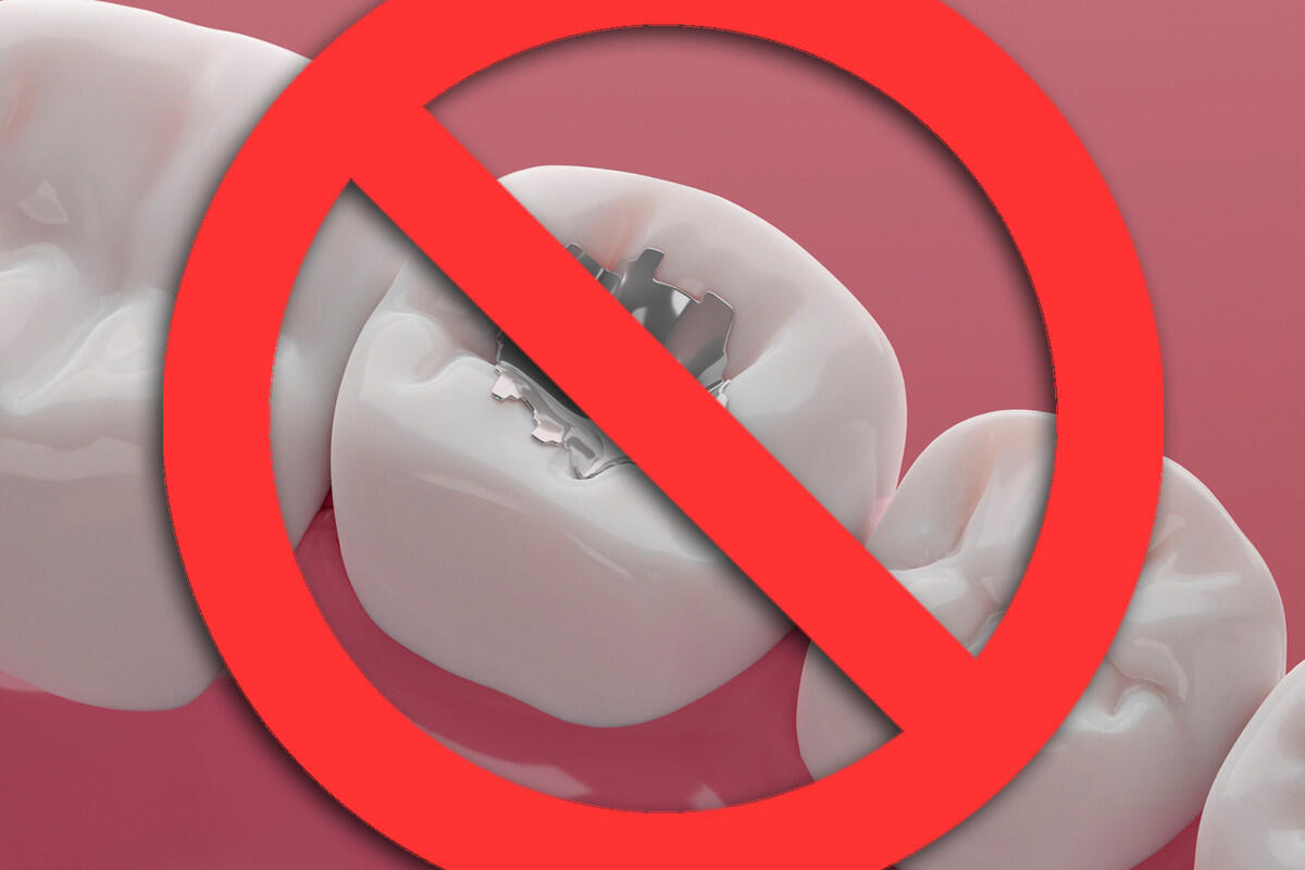 Amalgamverbaot ab 2025 in der EU  Amalgamverbaot ab 2025 in der EU