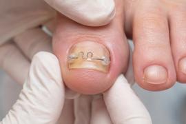 podologische Nagelkorrekturspange 
