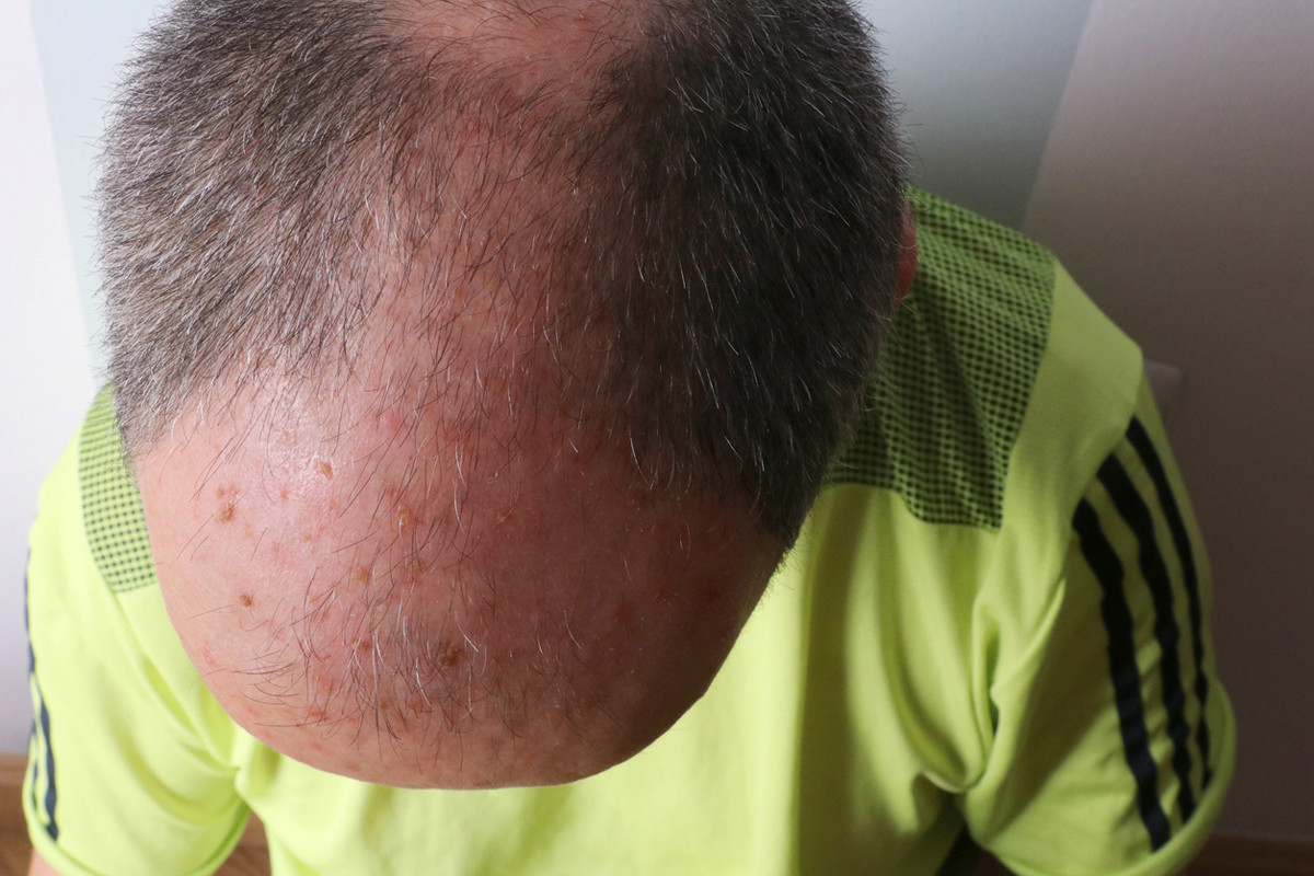 Aktinische Keratose auf der Kopfhaut Aktinische Keratose auf der Kopfhaut