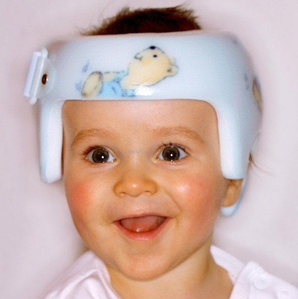 Helmtherapie bei Kleinkindern 