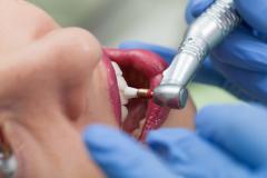 Zahnpoilitur bei Professioneller Zahnreinigung (PZR) 