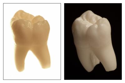 Zahnersatz und Zahnfüllungen könen aus Kunststoff, Amalgam oder Keramik gefertigt sein. 