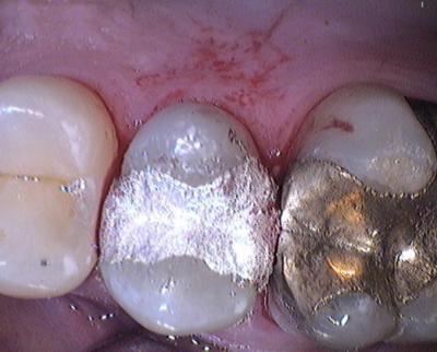 Zahnfüllung aus Amalgam