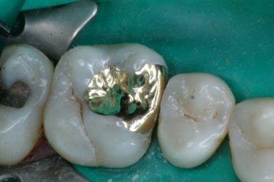 Zahnfüllung aus Gold