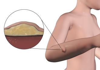 fettknoten unter der Hautoberfläche bei Lipödem
