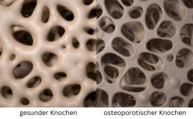Mikroskopische Aufnahmen eines gesunden und porösen Knochens  
