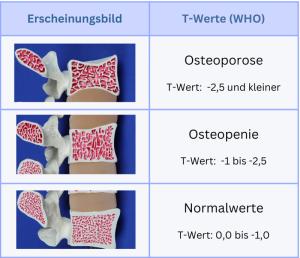 Einteilung Osteoporose vs Osteopenie anhand der T-Werte