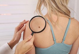 Hautscreening als Kassenleistung 